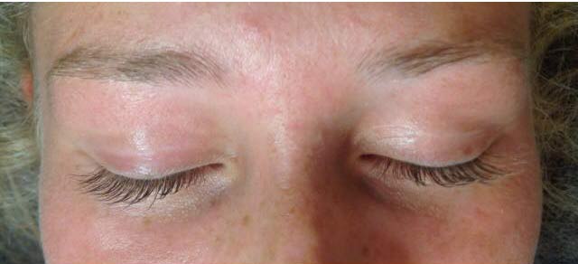eyebrows before treatment