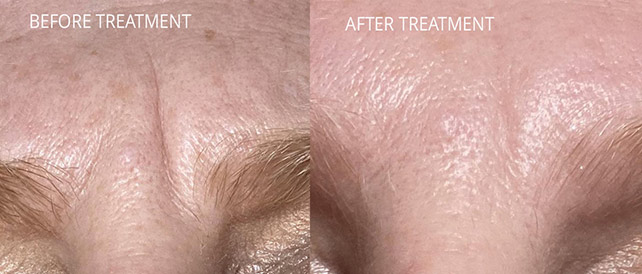 before and after microneedling with Dermapen