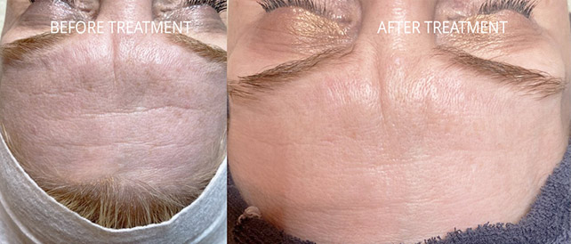 forehead before and after dermapen microneeding treatment at Beauty Divine